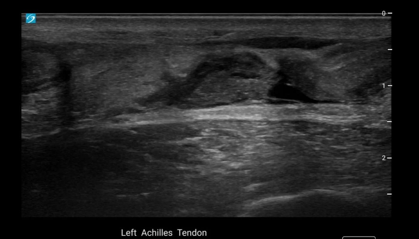 Ultrasound image showing achilles tendon tear