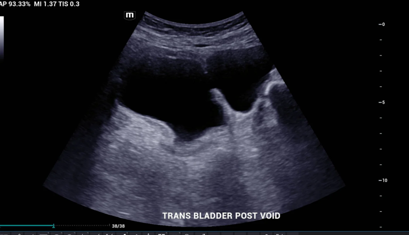 Ultrasound image showing bladder diverticulum