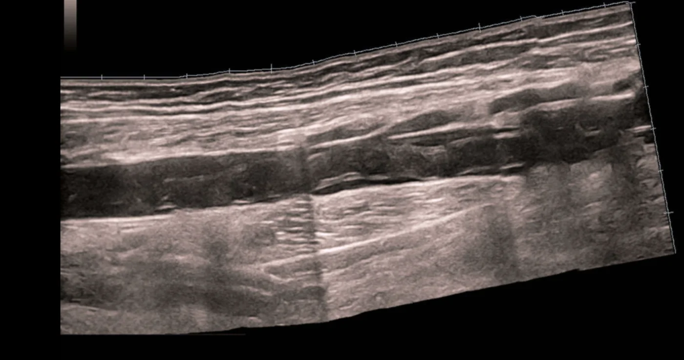 Ultrasound image showing clot along the femoral vein