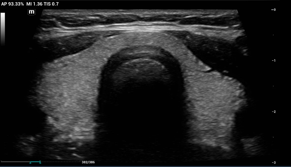 Ultrasound image showing normal thyroid