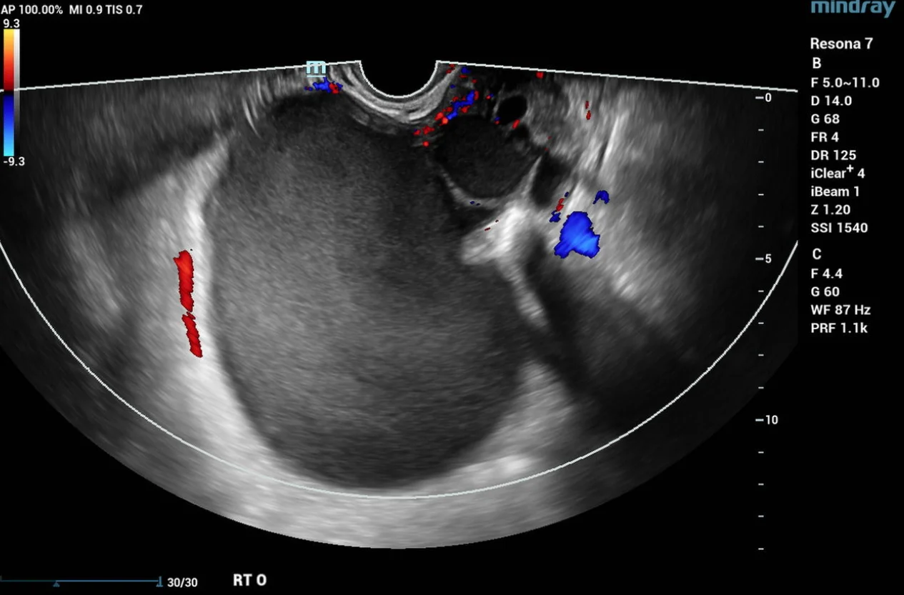 Ultrasound image showing ovarian endometrioma