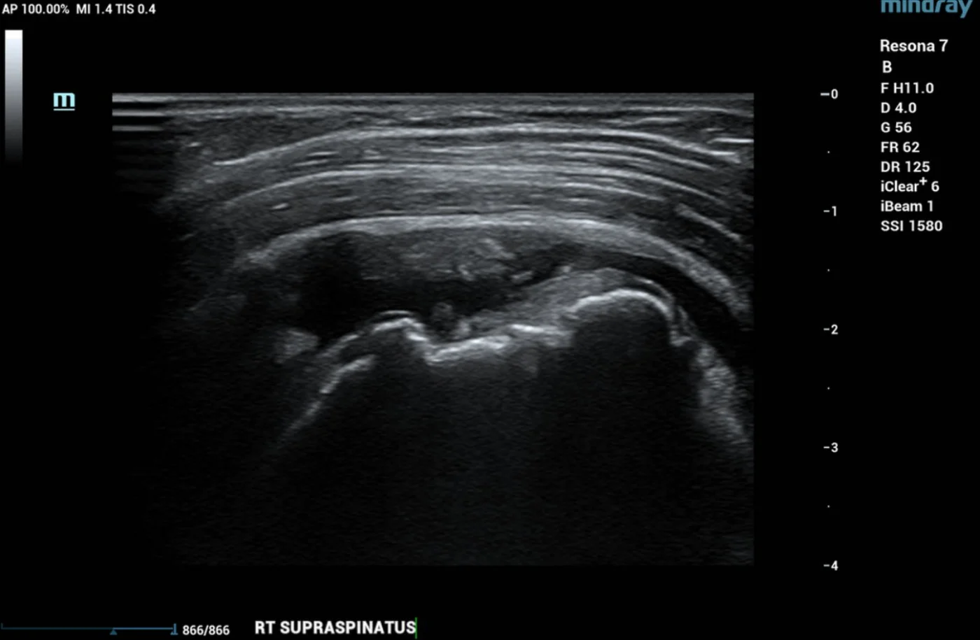 Ultrasound image showing full thickness rotator cuff tear
