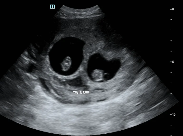 Ultrasound image showing twins