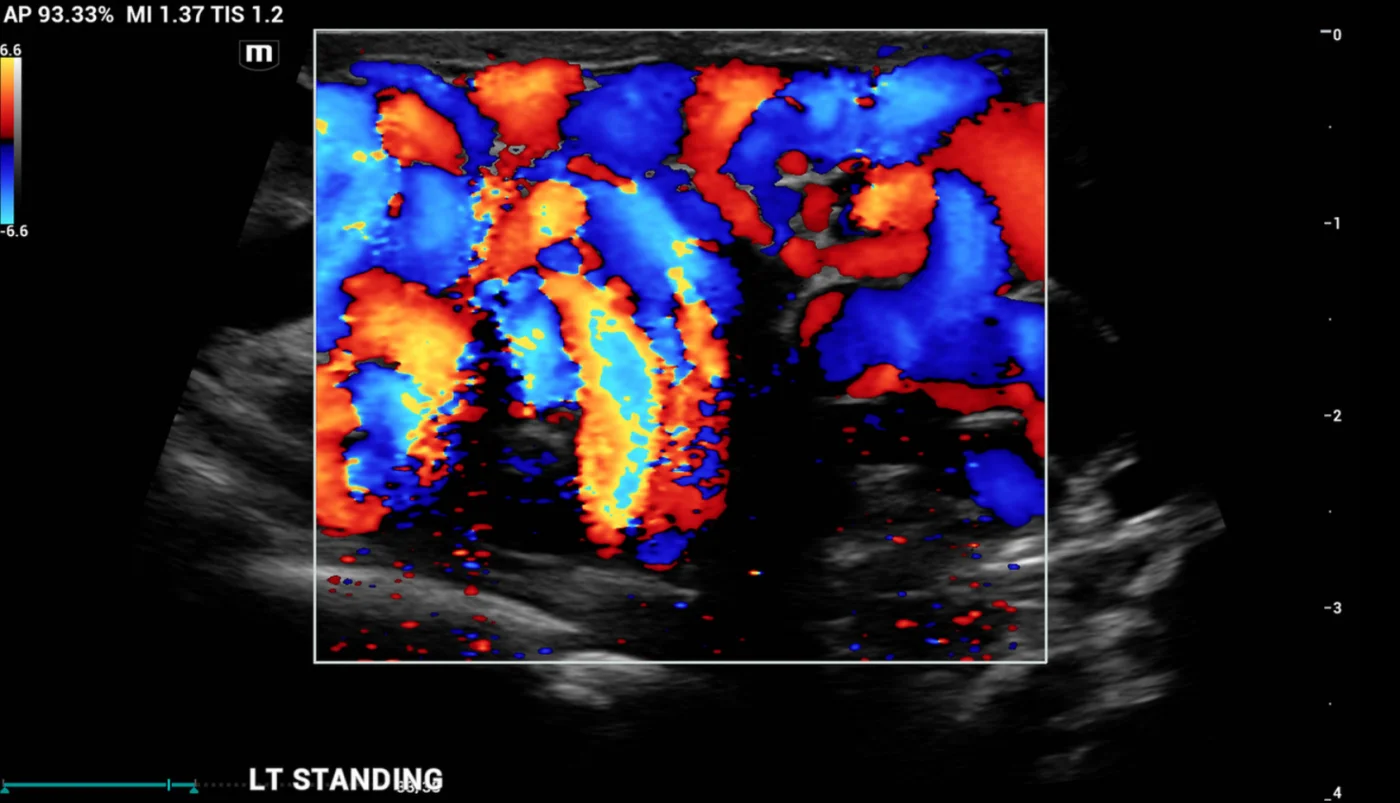 Ultrasound image showing scrotal varicocele